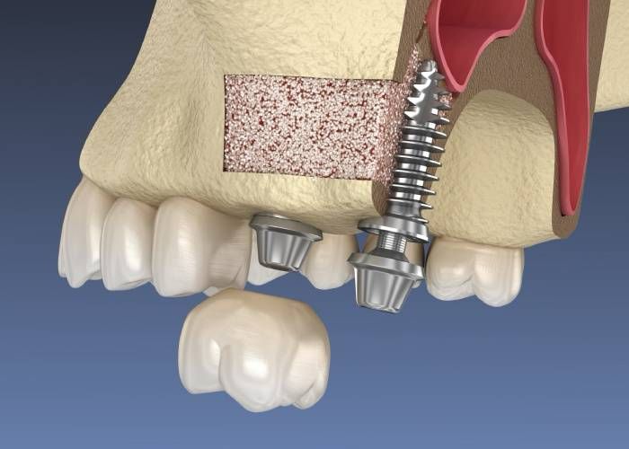 Intervento odontoiatrico