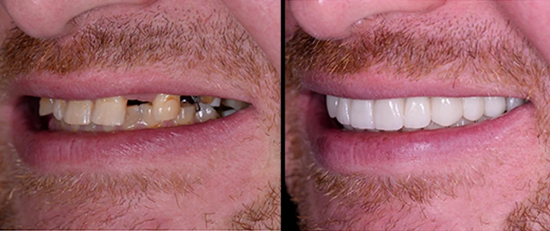 Dettaglio impianti dentali